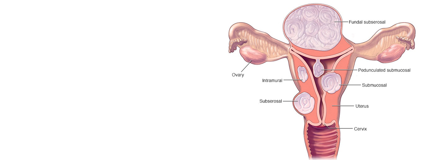 Myomectomy vs. Hysterectomy: Comparing Benefits, Procedures, and Recovery